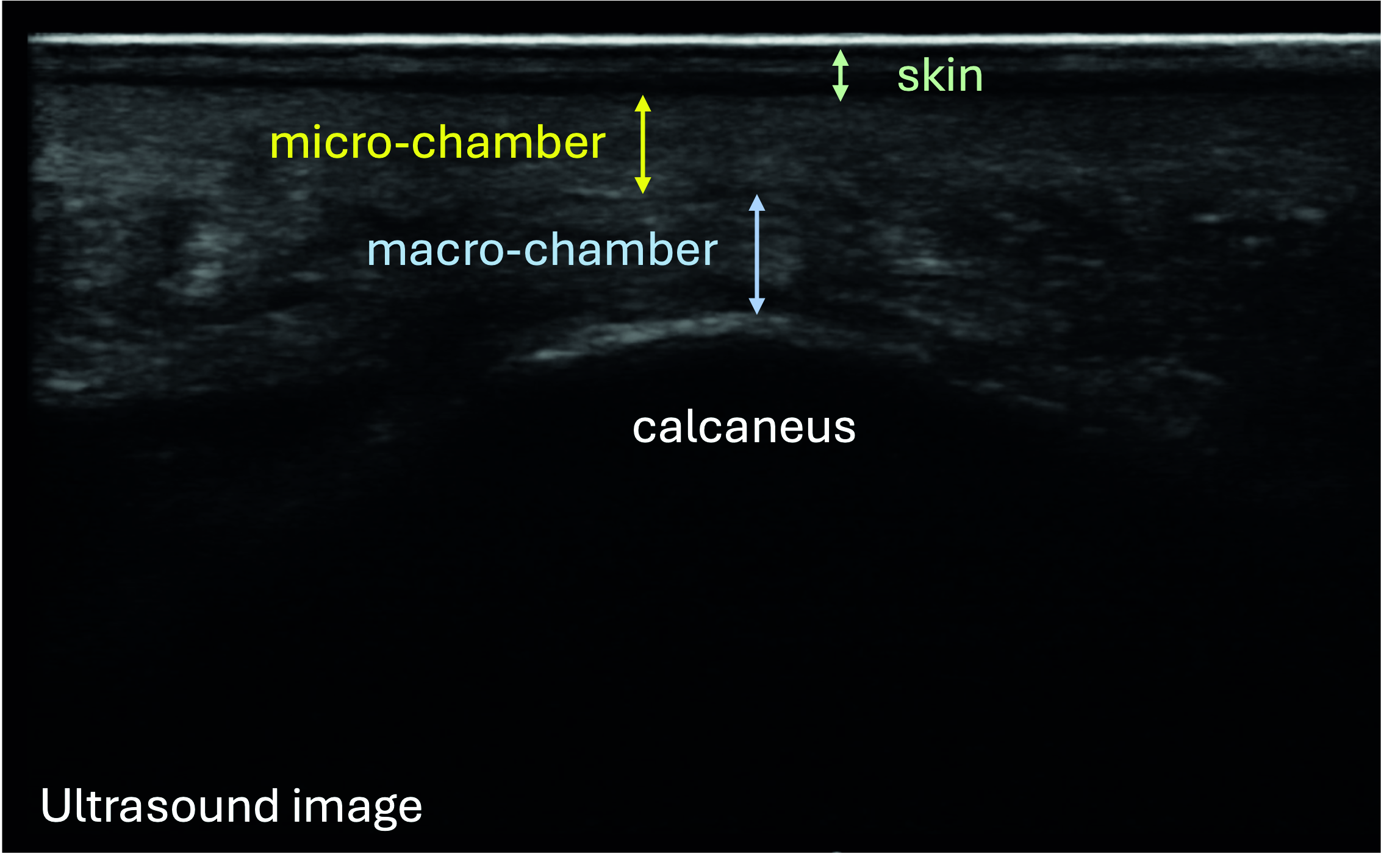 Labelled ultrasound image showing heel-pad tissue layers and the calcaneus.